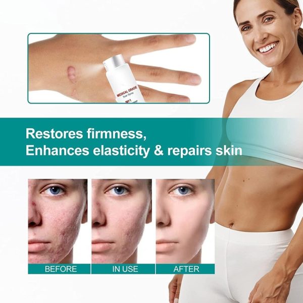 Scar Remove,scar Remove Medical Grade Scar Spray,medical Grade Scar Removal