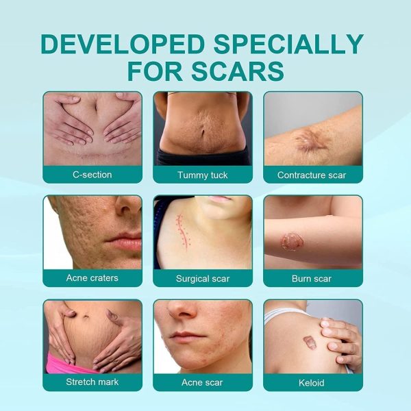 Scar Remove,scar Remove Medical Grade Scar Spray,medical Grade Scar Removal