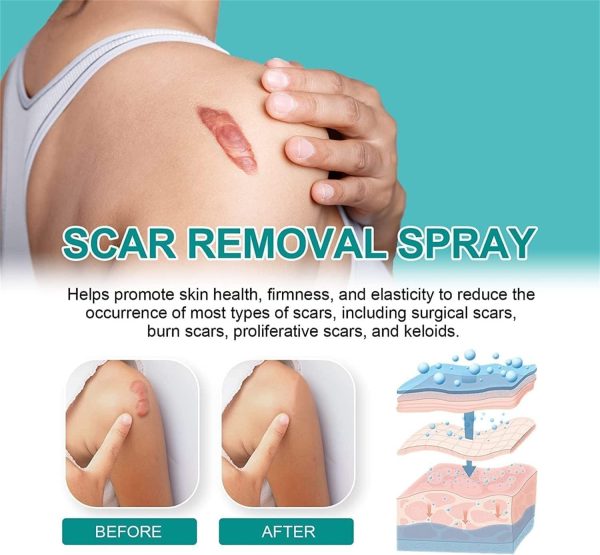 Scar Remove,scar Remove Medical Grade Scar Spray,medical Grade Scar Removal